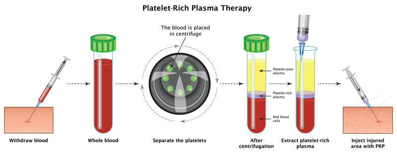 platelet